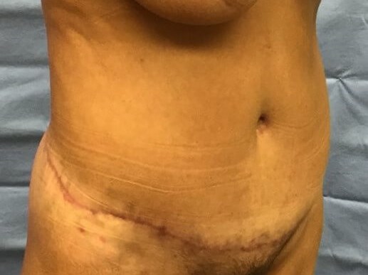 Oblique After