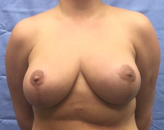 Anterior After