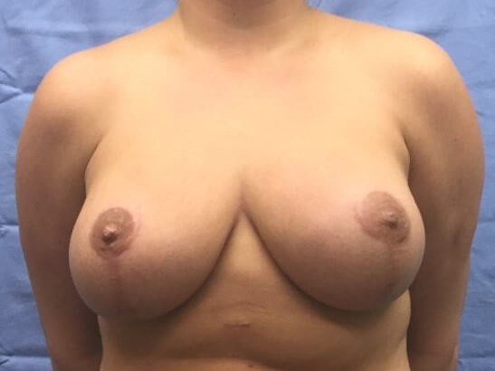 Anterior After