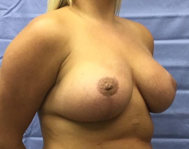 Oblique After