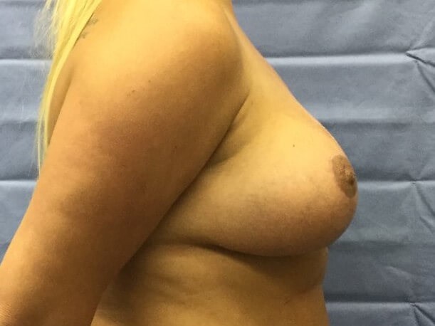 Side After