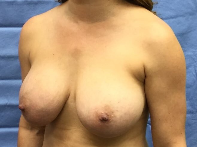 Oblique Before