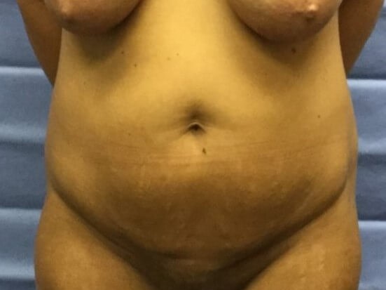 Anterior Before