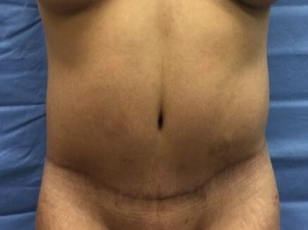 Anterior After