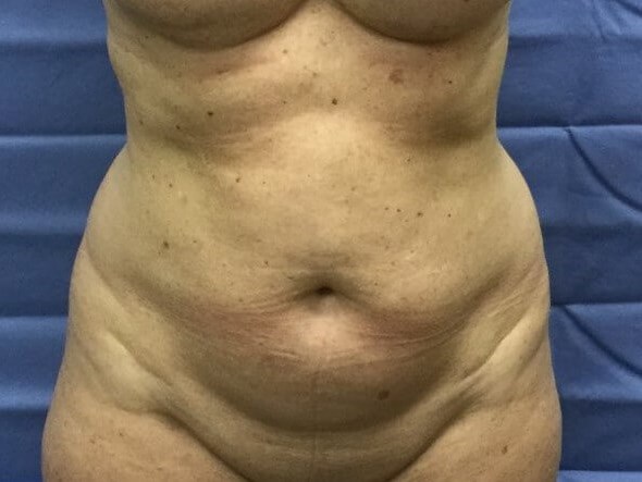 Anterior Before