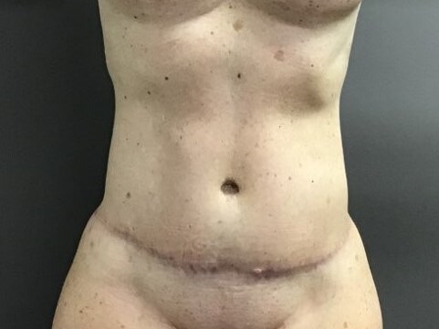 Anterior After