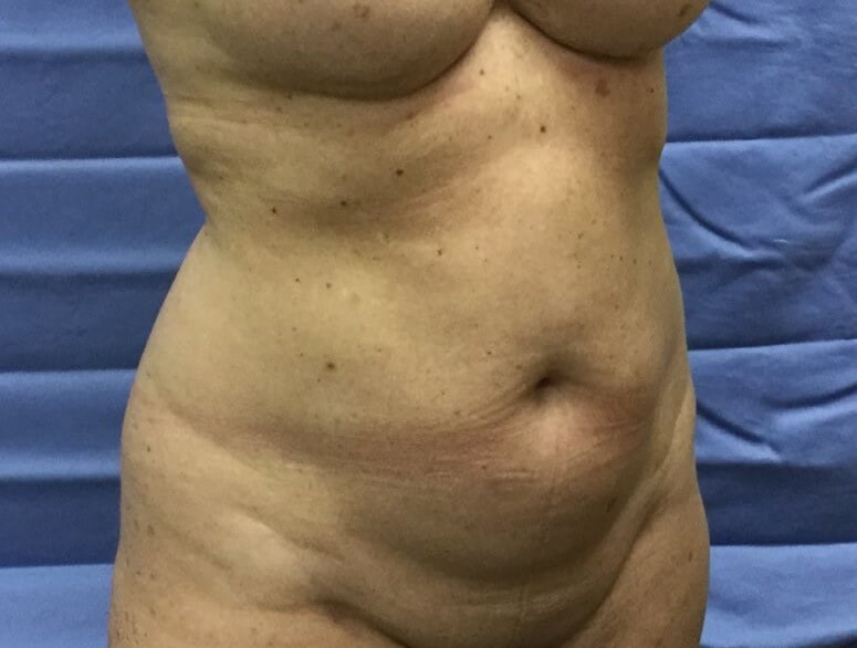 Oblique Before