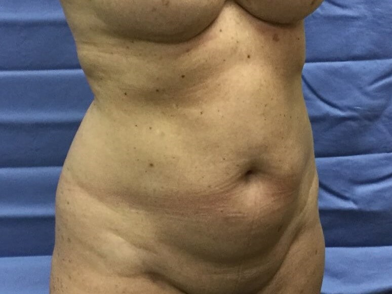 Oblique Before