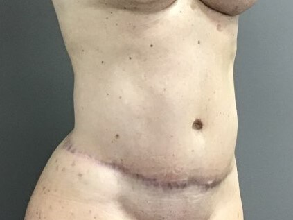 Oblique After