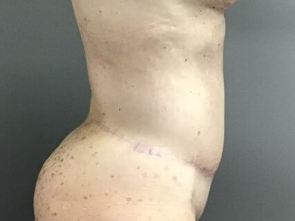 Side After