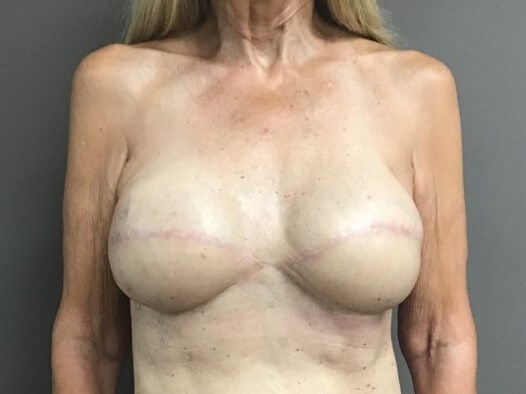 Anterior After