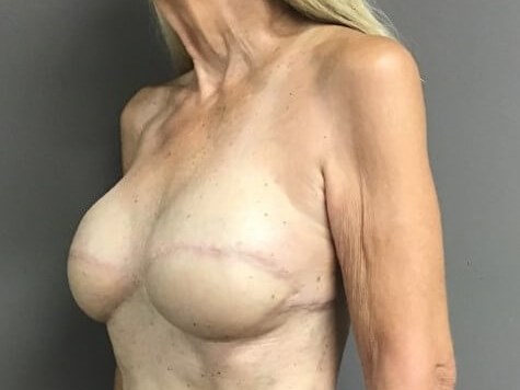 Oblique After