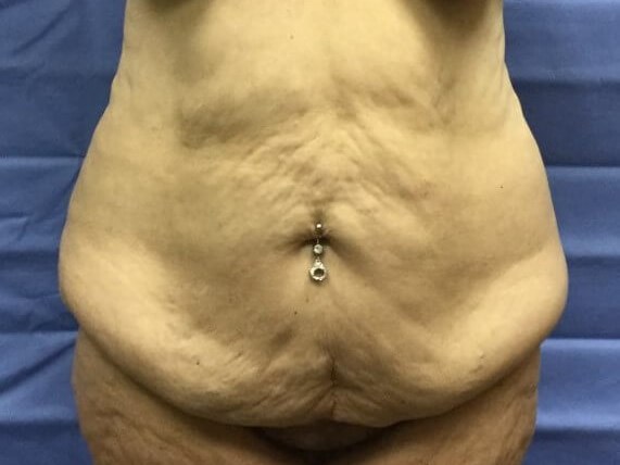 Anterior Before