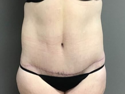 Anterior After