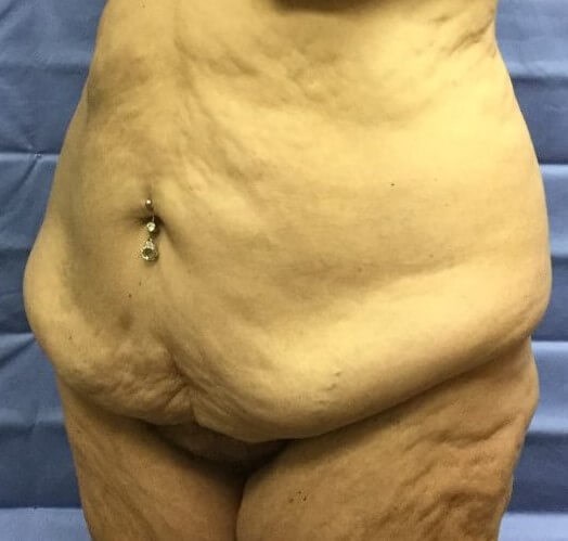 Oblique Before