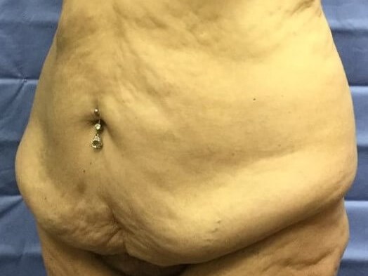 Oblique Before