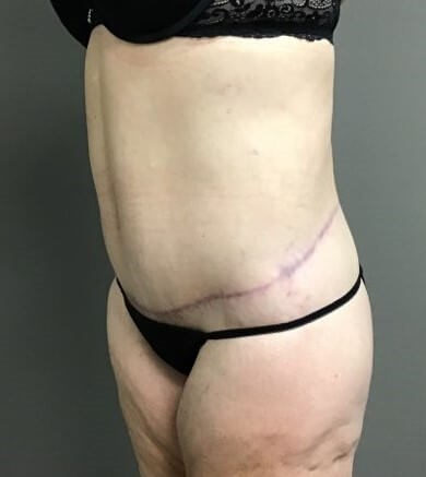 Oblique After