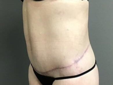 Oblique After