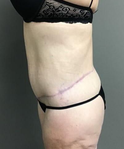 Side After
