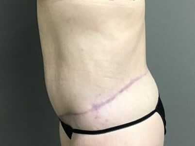 Side After