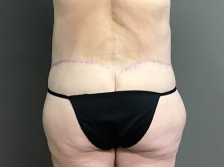 Back After