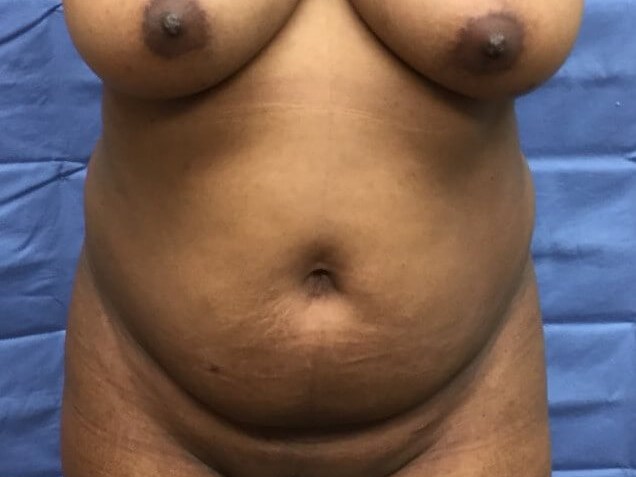 Anterior Before