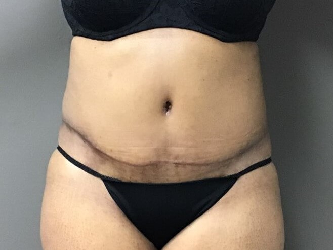 Anterior After