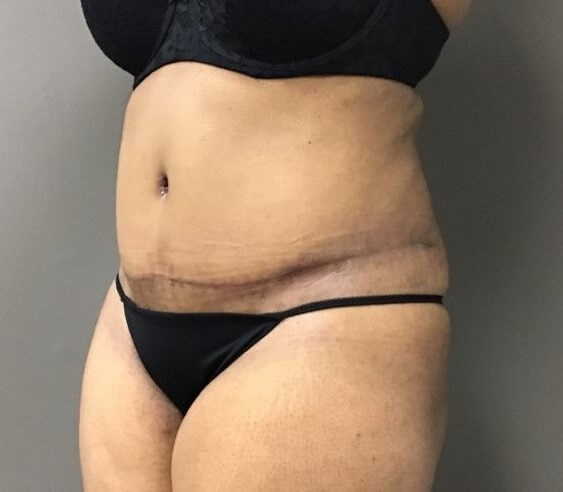 Oblique After