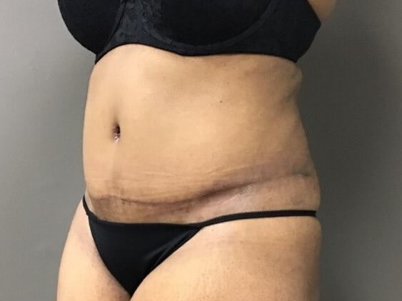 Oblique After