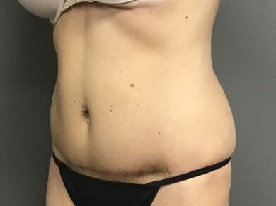 Oblique After