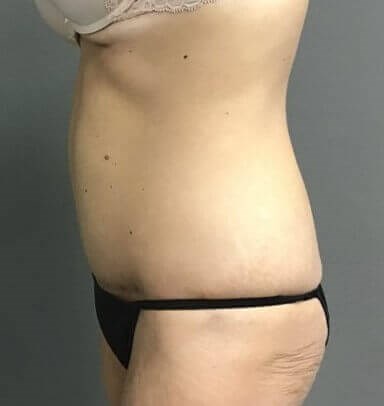 Side After