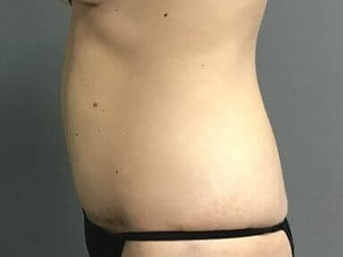 Side After