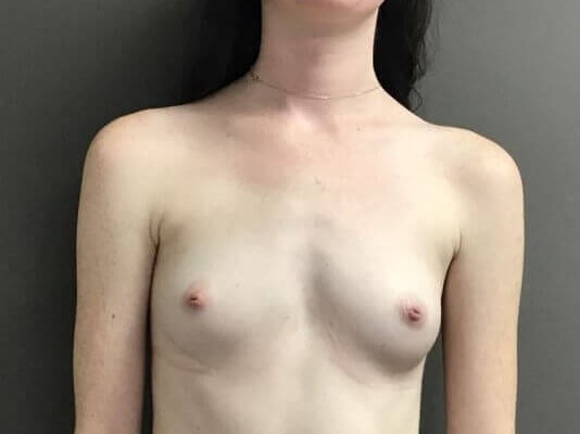Anterior Before