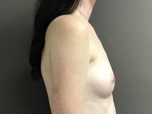 Side Before
