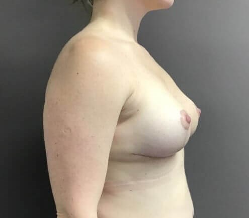 Side After