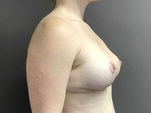 Side After