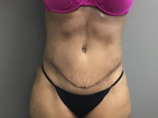 Anterior After