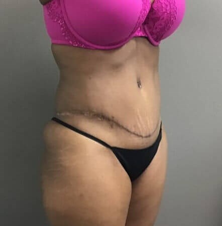Oblique After