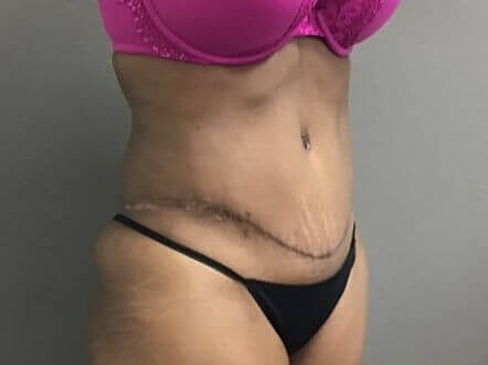 Oblique After