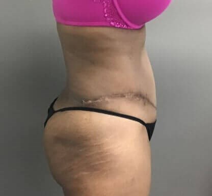 Side After