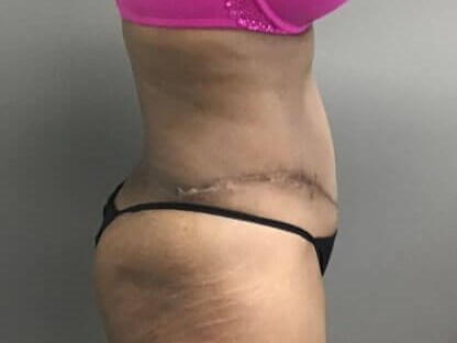 Side After