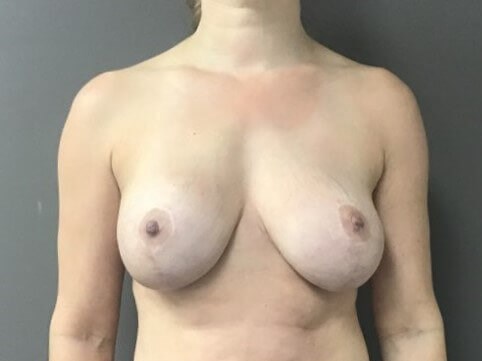 Anterior After