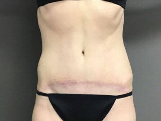 Anterior After