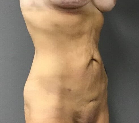 Oblique Before