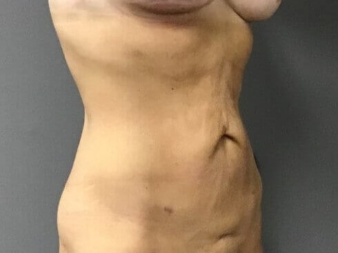 Oblique Before