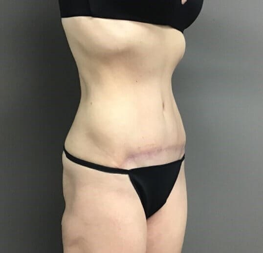 Oblique After