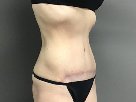 Oblique After