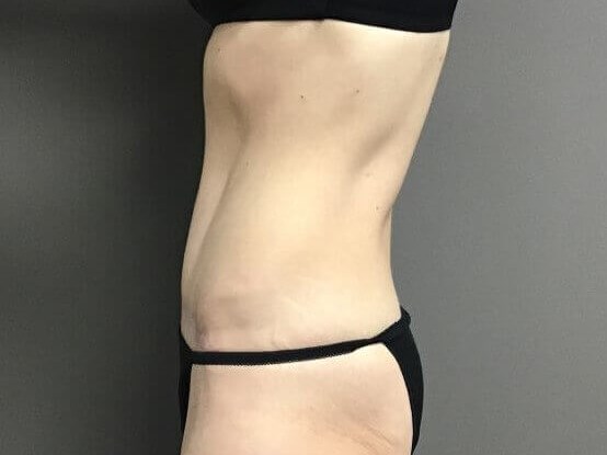 Side After