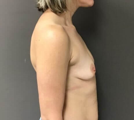 Side Before