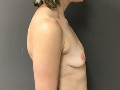 Side Before